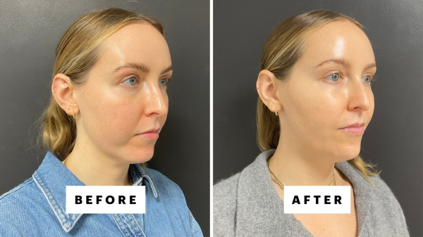 side by side before and after photos of woman with chin filler